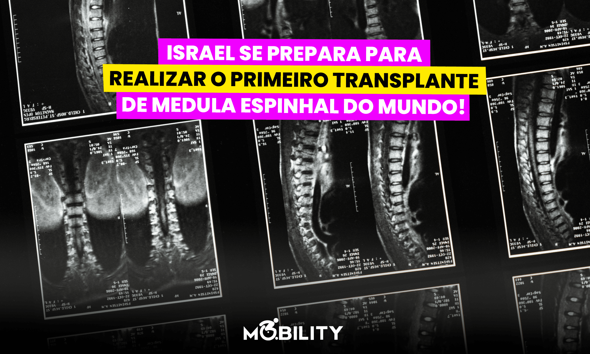 Avanço histórico: Israel se prepara para realizar o primeiro transplante de medula espinhal do mundo